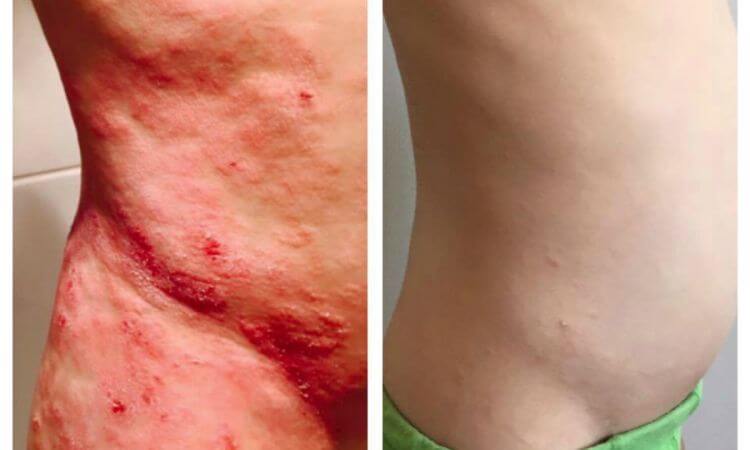 Eczema Treatment In Chawani