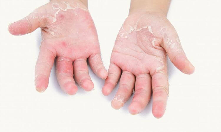 Psoriasis Treatment In Ganesh Nagar