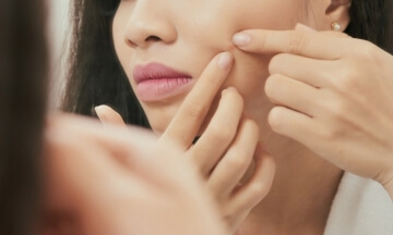 Pimples & Pigmentation Treatment In Naya Gaon