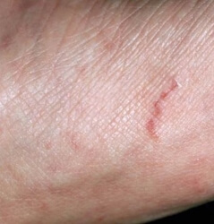 Skin Disease In Kishorepura